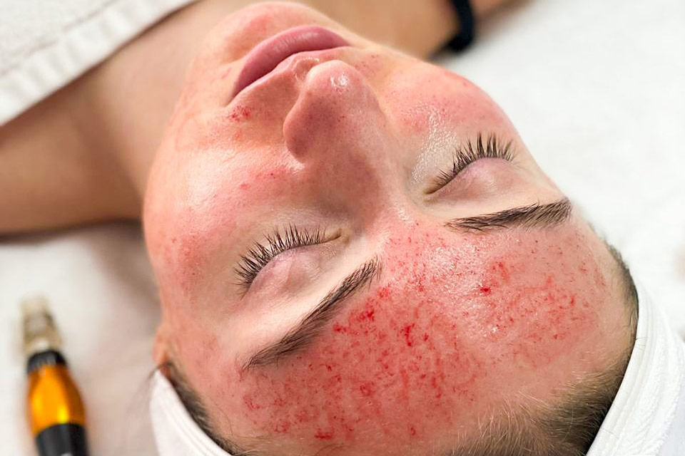 Microneedling at Avé Aesthetics in Queens NY