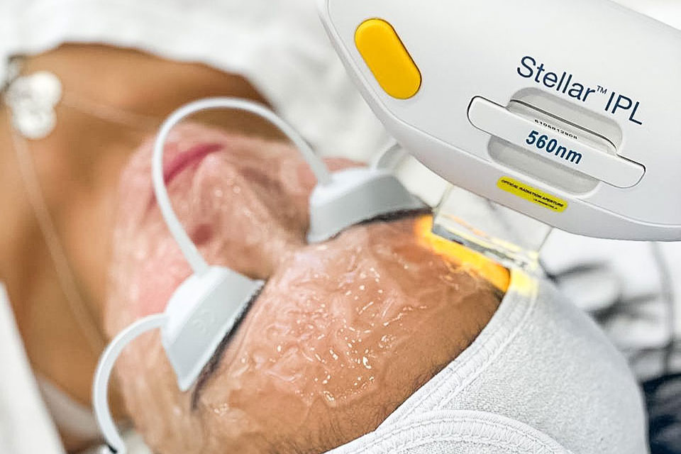 IPL at Avé Aesthetics in Queens NY